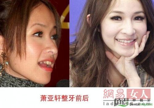 明星整牙都用什么方法